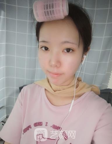 上海杨君毅磨骨实例,大方脸变成标准瓜子脸~