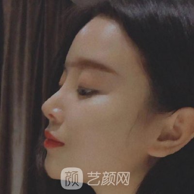 南昌甄美美容医院怎么样?全新隆鼻实例分享