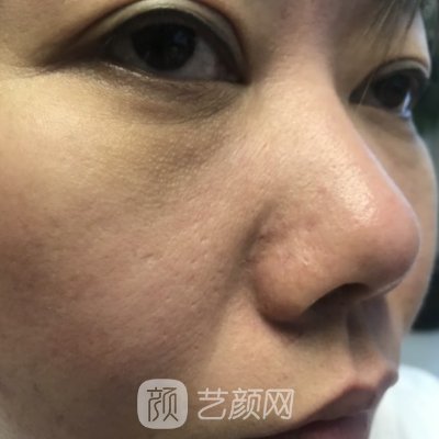 杭州华实医院整形科好吗?全新疤痕修复实例展示