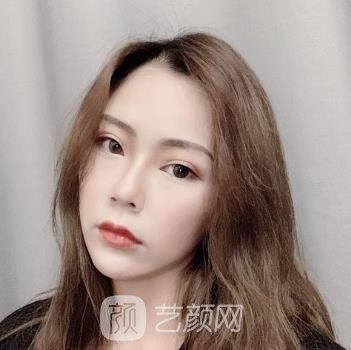 上海华美杨亚益手术怎么样？双眼皮实例+收费明细表更新