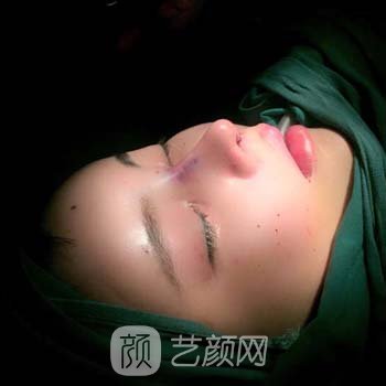 王军杰男士隆鼻实例，三个月后成果很惊艳