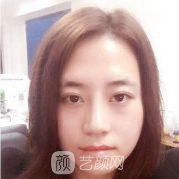 李永强隆鼻实例，鼻子高挺后，人生都圆满了