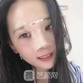 董亮隆鼻实例，鼻子的线条感和弧度都很优美，精致不少