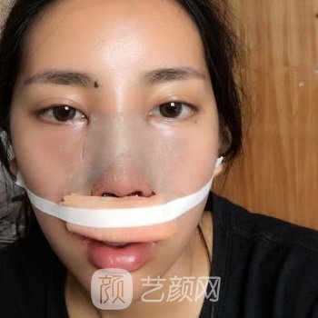 卢丙仑隆鼻实例，医生不错的技术让我变得这么美丽