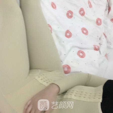 南京中医院整形科腰腹环吸实例公开|内附成果图