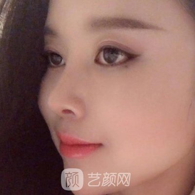 杭州美莱做鼻子怎么样?2023鼻子实例曝光