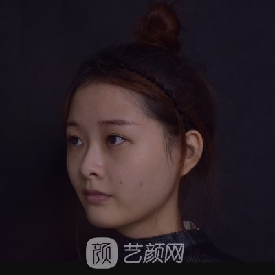 武汉美仑整形医院怎么样？亲身隆鼻整形实例一览