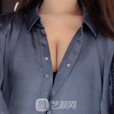 盐城艾美莉整形医院正规吗?脂肪丰胸实例分享