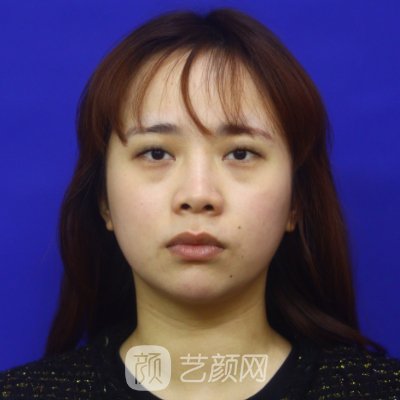 新疆华美李艳霞双眼皮技术怎么样？2023体验实例展示