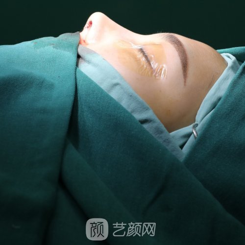 遵义利美康整形医院隆鼻实例上线｜亲身体验成果图分享