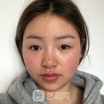 贵州旭美人整形医院怎么样?全新隆鼻实例曝光