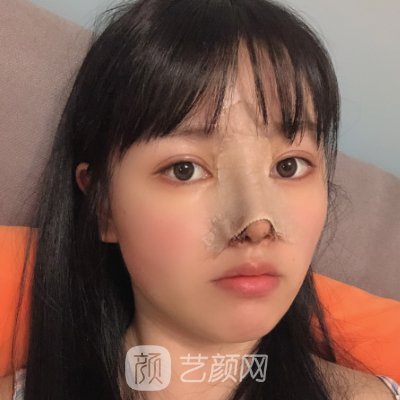 贵州旭美人整形医院怎么样?全新隆鼻实例曝光