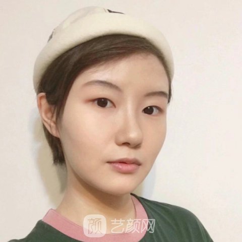 南京美莱美容医院口碑好吗?2023注射除皱实例分享