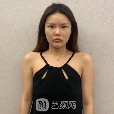 云南吴氏嘉美是正规医院吗?新版脂肪丰胸实例曝光