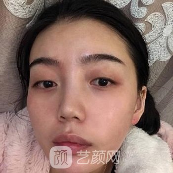 李丽强做双眼皮实例，手术后变成大眼萌女，电力满满