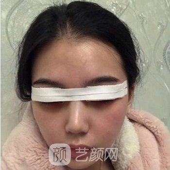 李丽强做双眼皮实例，手术后变成大眼萌女，电力满满