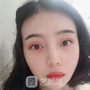 李丽强做双眼皮实例，手术后变成大眼萌女，电力满满