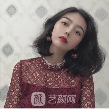 李丽强做双眼皮实例，手术后变成大眼萌女，电力满满