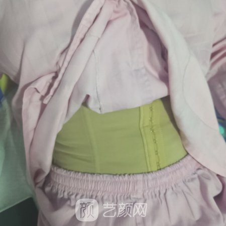 苏州康美美容医院吸脂技术怎么样？亲身体验实例一览