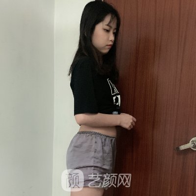 广州华美整形医院吸脂技术怎么样?医院招牌实例一览