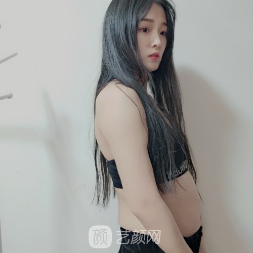 云南华美美莱整形医院吸脂实例出炉|成果无痕美观