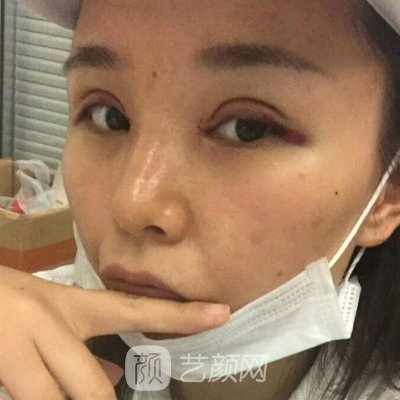 宁波美莱整形美容医院正规吗?崭新双眼皮整形实例曝光