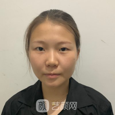 郑州元素美学整形医院正规吗？新版双眼皮整形实例分享