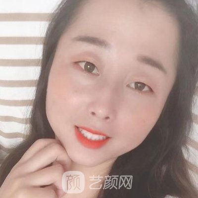 长春伊美整形医院咋样？新版嫩肤除皱实例公开