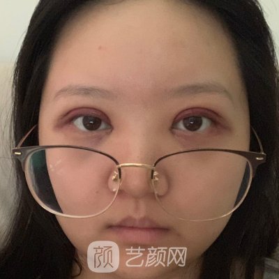 杭州群英整形医院眼综合实例曝光｜成果自然无痕