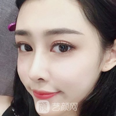 贵阳美贝尔徐威做鼻子好吗？2023体验实例曝光