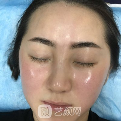 杭州媛颂医美光子嫩肤实例出炉|附体验成果同