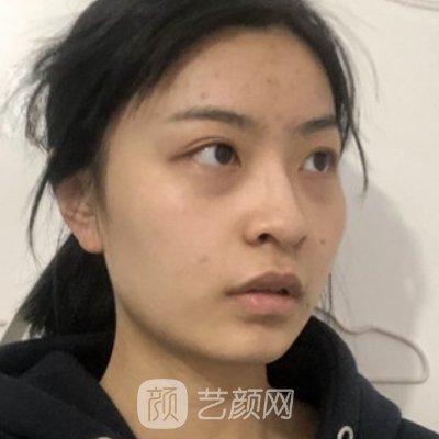 扬州施尔美整形医院祛眼袋怎么样？亲身体验实例展示