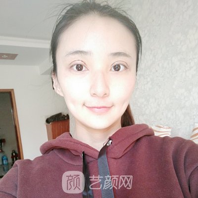 北京丽都整形美容医院口碑好吗?崭新双眼皮整形实例出炉