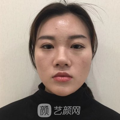 遵义韩美美容医院软骨隆鼻实例出炉｜内附体验感悟