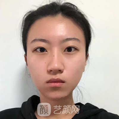 长春医美美容医院玻尿酸注射除皱实例分享|成果自然无痕