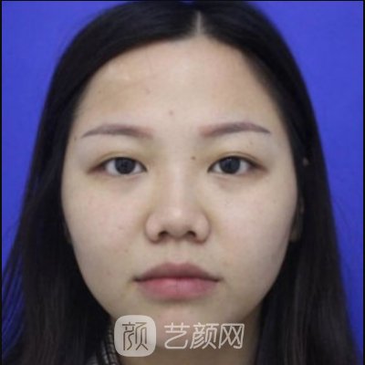 烟台华怡整形医院注射隆鼻实例分享|亲身体验详情集中一览