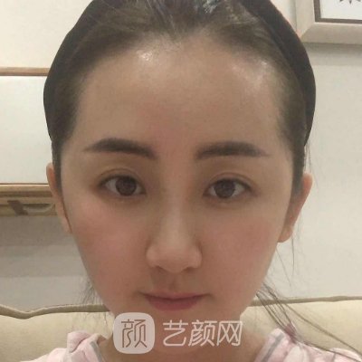 南京施尔美整形医院瘦脸除皱实例出炉｜内含亲身体验感悟