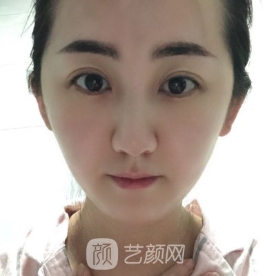 南京施尔美整形医院瘦脸除皱实例出炉｜内含亲身体验感悟