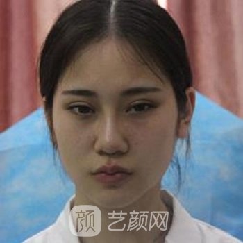 徐敦医生隆鼻实例，术后鼻子高挺、容颜精致，妥妥的小仙女