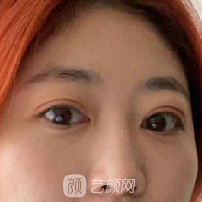 郴州唯美尹伟力做眼袋手术怎么样？医生招牌实例一览