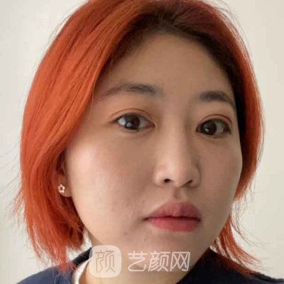 郴州唯美尹伟力做眼袋手术怎么样？医生招牌实例一览