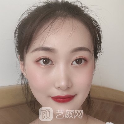 成都美莱黄小林双眼皮修复怎么样？90天修复细节图一览