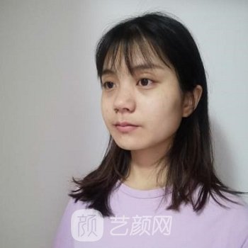 沈阳杏林朱石江隆鼻实例，术后变得更加明媚，不再是照骗