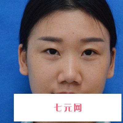 重庆美莱整形医院割双眼皮怎么样?全新体验实例发布