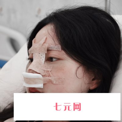 北京正美郑永生隆鼻实例公开|附体验对比图