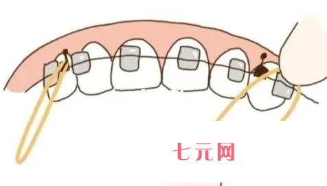 牙齿矫正动漫36.jpg