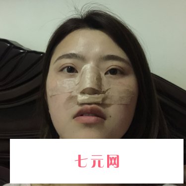 上海玫瑰范锴医生做鼻子怎么样?全新体验实例一览