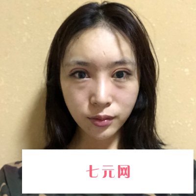 沈阳杏林赵迪做双眼皮自然吗？90天体验实例公布