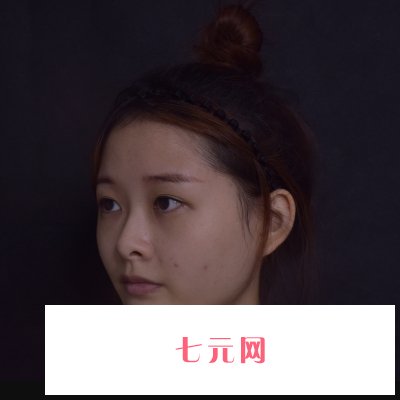 郑州集美陈曦做鼻子怎么样？医生招牌实例曝光