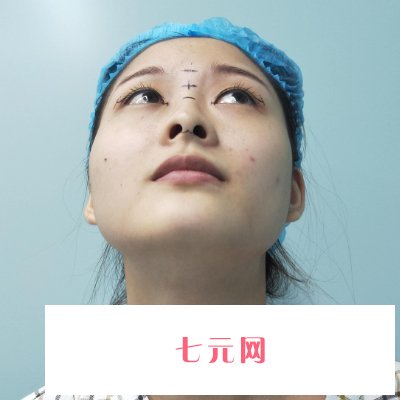 郑州集美陈曦做鼻子怎么样？医生招牌实例曝光